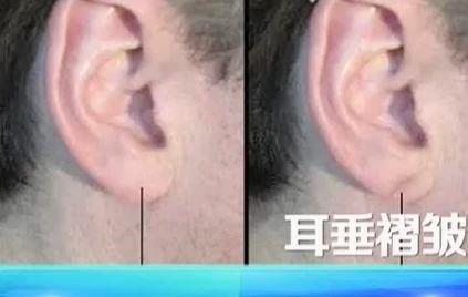 血管不好从脸上、腿上就能看出来 有这6个症状要警惕！