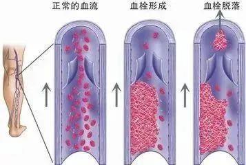 如何预防“经济舱综合征”？照这四个字做