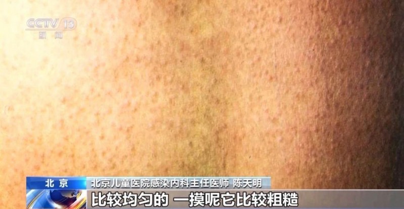 孩子发热、咽痛还伴皮疹，“小红人”到底是种什么病？