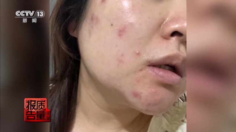 每周质量报告丨“针清”后痘痘不减反增 这些祛痘法操作不当可能会“烂脸”