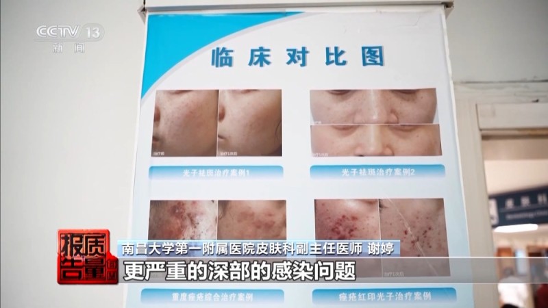 每周质量报告丨“针清”后痘痘不减反增 这些祛痘法操作不当可能会“烂脸”