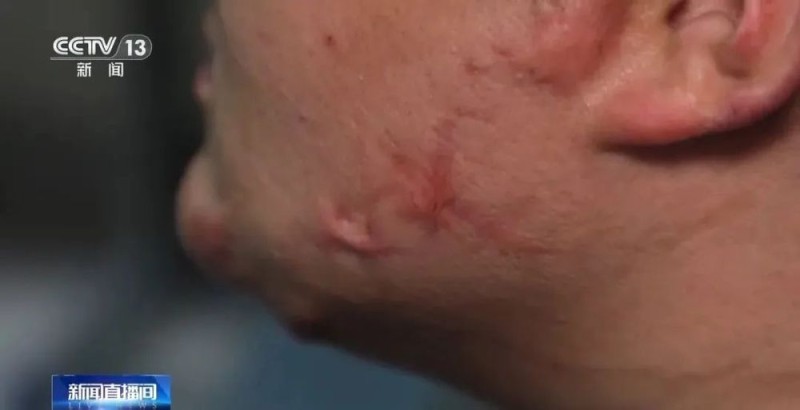 可在呼吸道爆燃！有学生吸食火机气体成瘾……