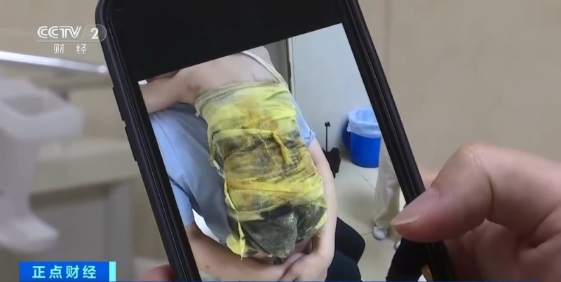 夏季高发儿童烫伤 处理不当或致严重感染