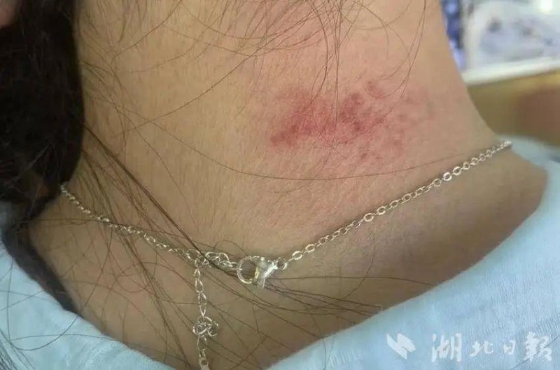 女子戴项链被诊断为“首饰性皮炎” 医生：不要长时间佩戴