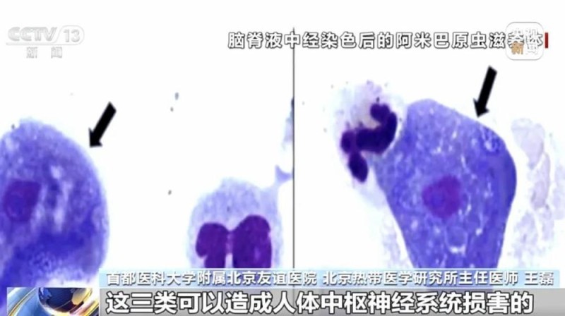 一月两起“食脑虫”夺命悲剧 玩水如何避开致命威胁？