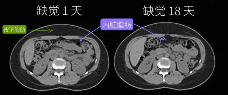 注意！缺觉，可能会让你加速变胖