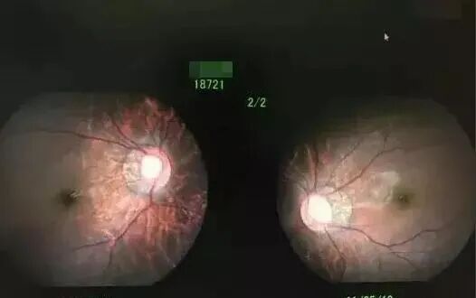 5岁男童近视近1000度，不可逆转！这个习惯害了他