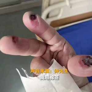杭州女子误踩氢氟酸身亡，一男子戴两层手套误碰致3根手指灼出洞！警惕清洁剂中隐藏的“化骨水”