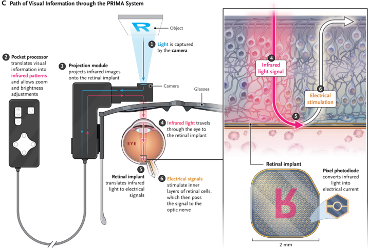 一副 AI 眼镜,让 500 万盲人有了重见光明的希望