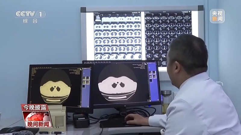 肺结节≠肺癌 专家建议这些人群应做胸部CT