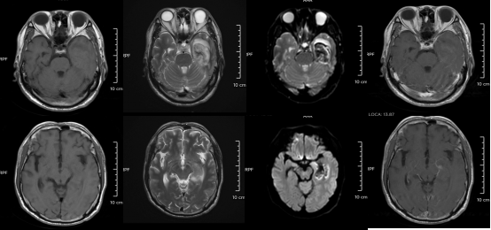 30岁小伙长期熬夜智力退回3岁 年轻人患“脑膜炎”病例为何频发?