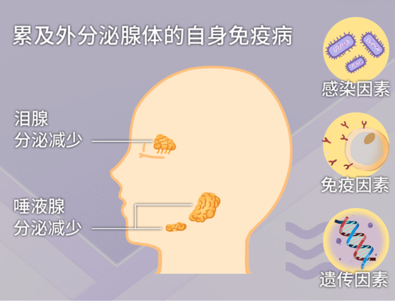 总是感觉口干舌燥？小心患上干燥综合征