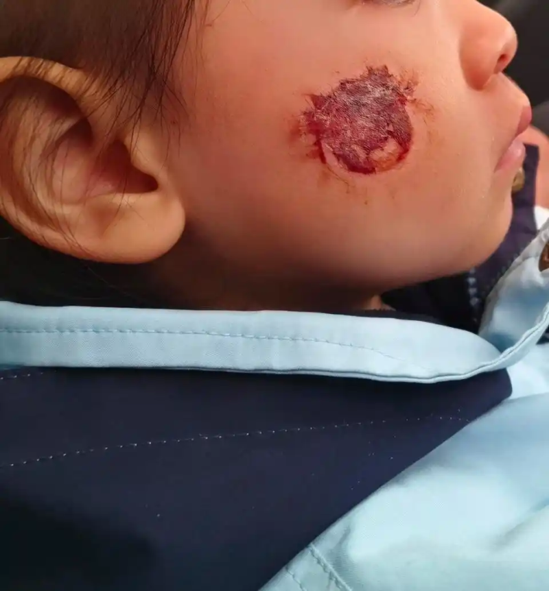 “毒贴纸”致3岁女童患急性接触性皮炎 这些儿童玩具也暗藏风险