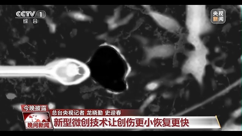 肺结节≠肺癌 专家建议这些人群应做胸部CT