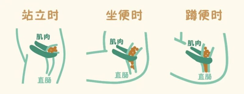 真心建议：如厕方式这样选，更健康！